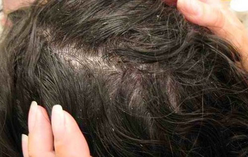 Cara Penggunaan Minyak Zaitun Untuk Rambut sebagai pembasmi kutu rambut