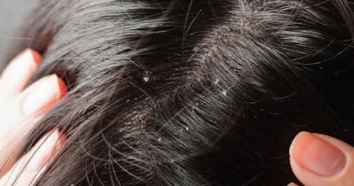 Cara Penggunaan Minyak Zaitun Untuk Rambut yang ketombe
