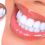 Dua Metode Harga Veneer Gigi Yang Perlu Di Ketahui Pada Tahun 2022